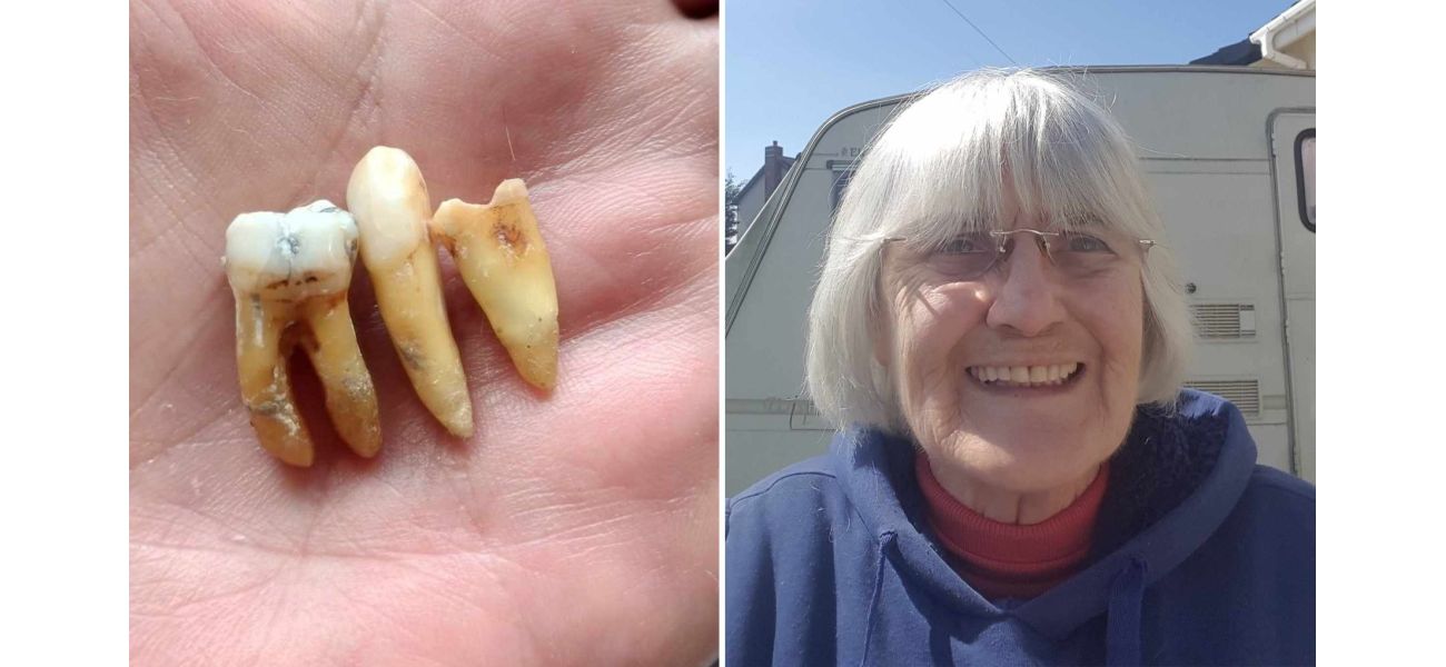 After six years of waiting for a dentist, I finally removed three of my own teeth.