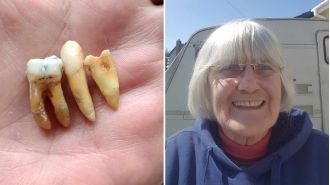 After six years of waiting for a dentist, I finally removed three of my own teeth.