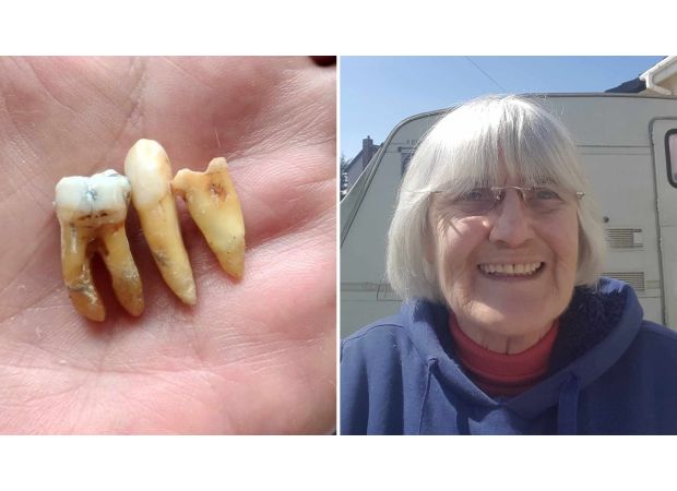 After six years of waiting for a dentist, I finally removed three of my own teeth.