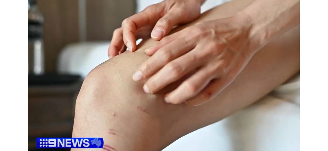 Medication for eczema that could have had a $20,000 increase in price is now available, bringing relief to those who suffer from the condition.
