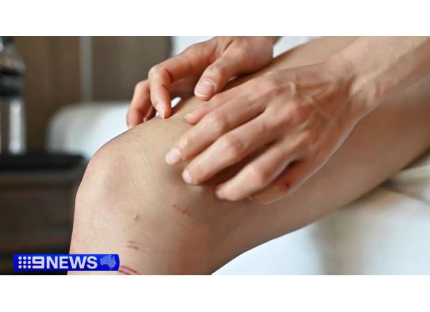 Medication for eczema that could have had a $20,000 increase in price is now available, bringing relief to those who suffer from the condition.