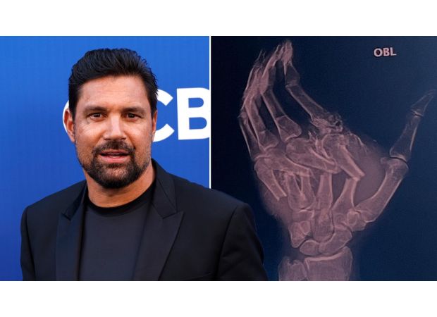 The actor from The Hobbit suffers severe injuries in a scary dune buggy accident.