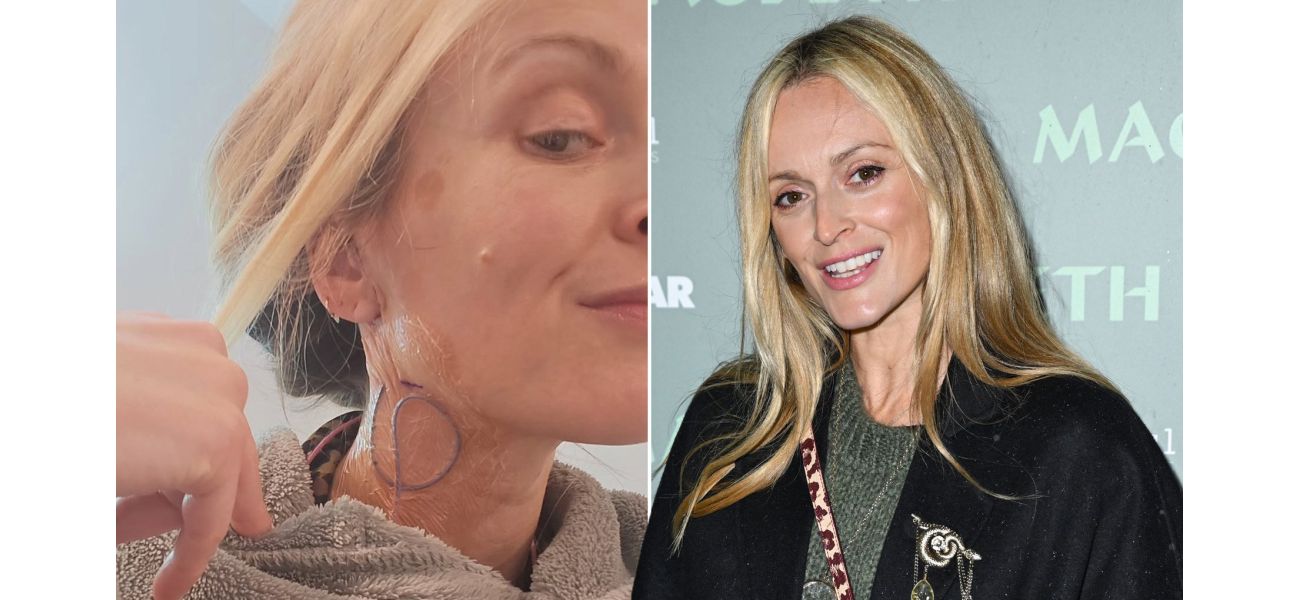 Fearne Cotton bravely displays post-surgery scars, embracing them as a symbol of strength and courage.