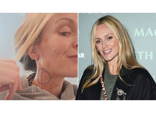 Fearne Cotton bravely displays post-surgery scars, embracing them as a symbol of strength and courage.