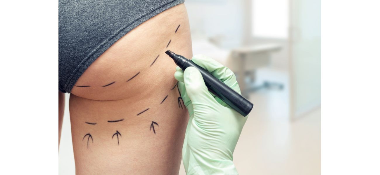 Health official cautions against cheap buttock enhancement procedures during holiday season.