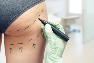 Health official cautions against cheap buttock enhancement procedures during holiday season.