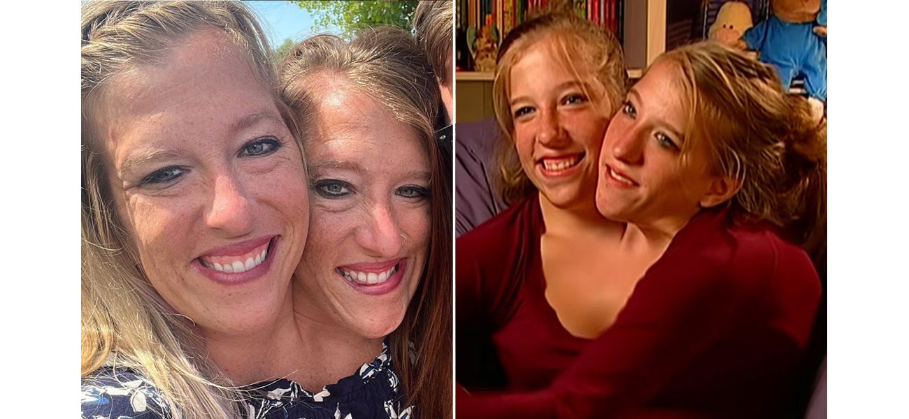 Conjoined twins reveal truth about their physical connection.