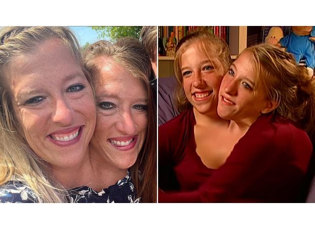 Conjoined twins reveal truth about their physical connection.