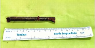Man accidentally ends up with three inch chopstick lodged in eye after bumping into a friend while intoxicated.