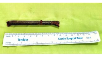 Man accidentally ends up with three inch chopstick lodged in eye after bumping into a friend while intoxicated.
