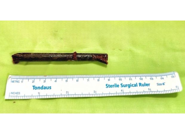 Man accidentally ends up with three inch chopstick lodged in eye after bumping into a friend while intoxicated.