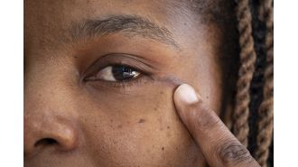 A tumor was successfully removed from a woman's head in the UK using a groundbreaking operation through her eye socket.