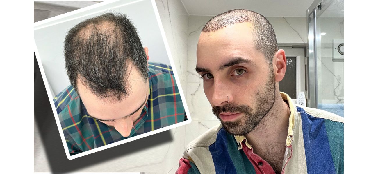 A month ago, I underwent a hair transplant and here is my experience.