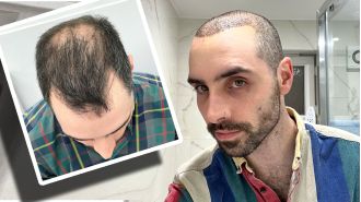 A month ago, I underwent a hair transplant and here is my experience.