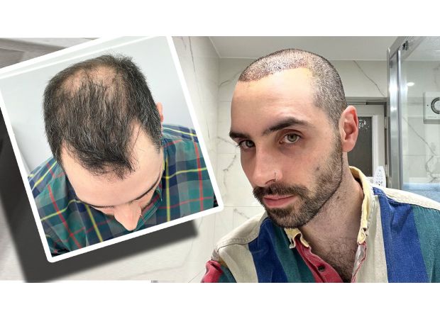 A month ago, I underwent a hair transplant and here is my experience.