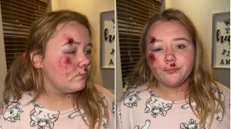 12-year-old girl injured on road in hit-and-run.