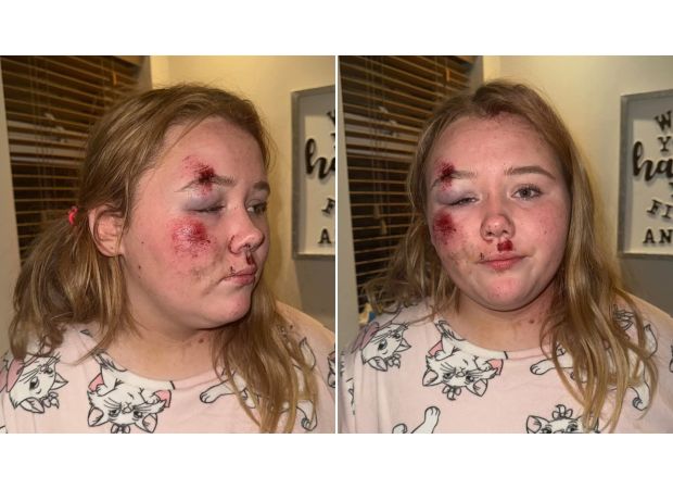 12-year-old girl injured on road in hit-and-run.