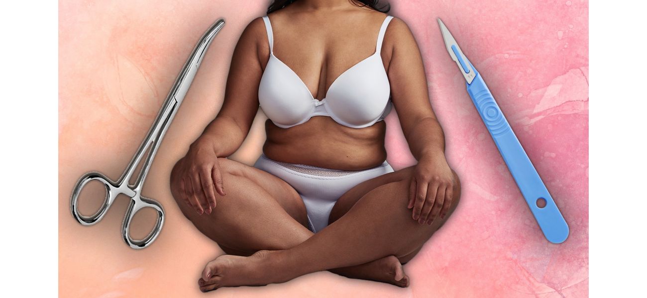 Monsplasty is a new option for women who want a customized vagina through cosmetic surgery.