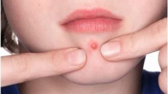 Popping pimples has consequences, so think twice before you do it.