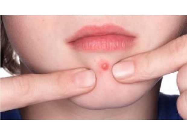 Popping pimples has consequences, so think twice before you do it.