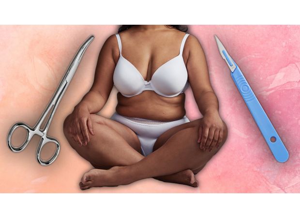 Monsplasty is a new option for women who want a customized vagina through cosmetic surgery.