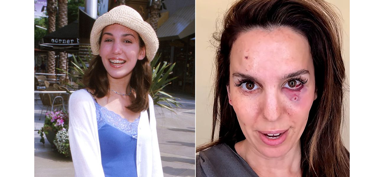 Disney celebrity shares shocking wound from being shot in the face during husband's birthday vacation.