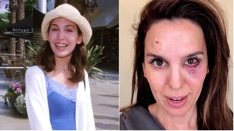 Disney celebrity shares shocking wound from being shot in the face during husband's birthday vacation.