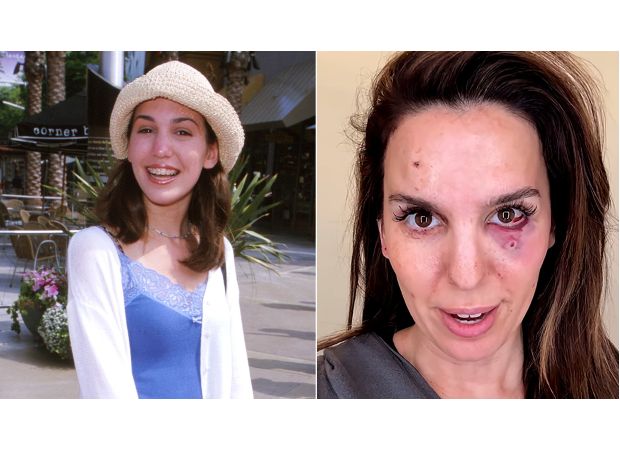 Disney celebrity shares shocking wound from being shot in the face during husband's birthday vacation.