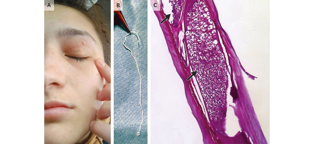A woman's forehead was infested with a worm from her pet dog that eventually moved into her eye.