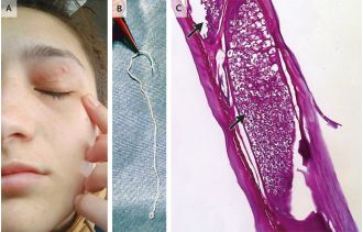 A woman's forehead was infested with a worm from her pet dog that eventually moved into her eye.