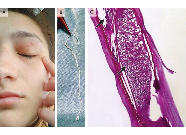A woman's forehead was infested with a worm from her pet dog that eventually moved into her eye.