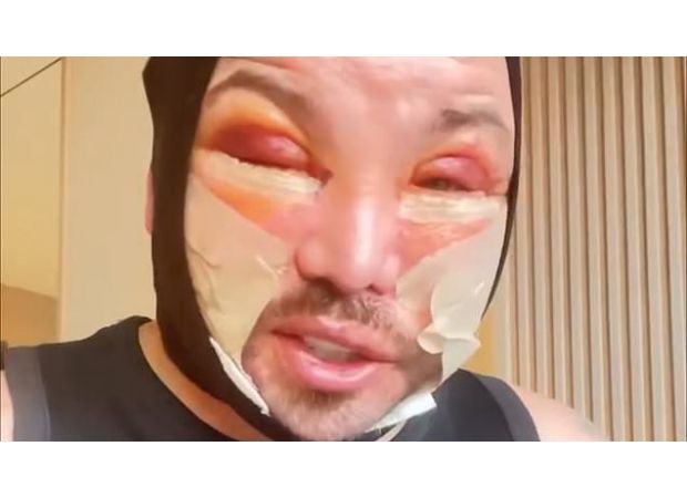 Bobby Norris shares post-surgery face swelling, video causes confusion.